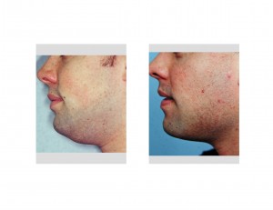 buccal-lipectomy-and-neck-liposuction-dr-barry-eppley-indianapolis