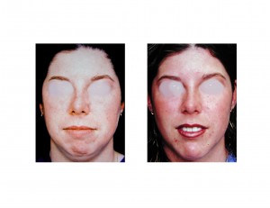 chubby-face-correction-dr-barry-eppley-indianapolis