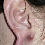 gauged-ear-deformity-dr-barry-eppley-indianapolis