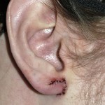 gauged-ear-reconstruction-dr-barry-eppley-indianapolis1
