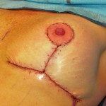 laser-bra-lift-skin-closure-dr-barry-eppley-indianapolis