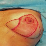 laser-bra-lift-skin-removal-dr-barry-eppley-indianapolis