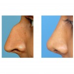 hooked-nose-witchs-nose-rhinoplasty-indianapolis-dr-barry-eppley
