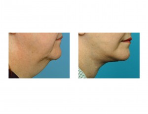 facelift-dr-barry-eppley-indianapolis