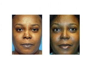 rib-rhinoplasty-dr-barry-eppley-indianapolis