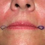 corner-of-mouth-lift-markings-dr-barry-eppley-indianapolis