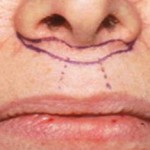 subnasal-lip-lift-indianapolis-dr-barry-eppley