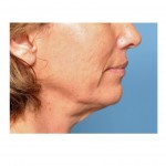 early-neck-sagging-dr-barry-eppley-indianapolis1