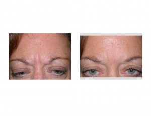 glabellar-frown-line-implants-dr-barry-eppley-indianapolis