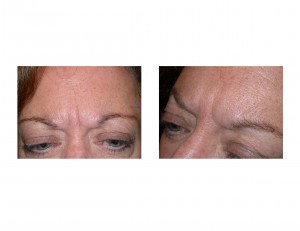 glabellar-frown-lines-dr-barry-eppley-indianapolis