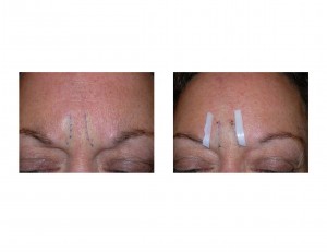 glabellar-furrow-implants-dr-barry-eppley-indianapolis