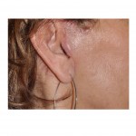 limited-facelift-scar-dr-barry-eppley-indianapolis2