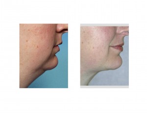 neck-liposuctin-without-chin-implant-dr-barry-eppley-indianapolis