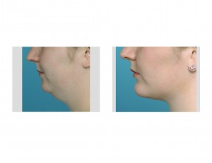 neck-liposuction-with-chin-implant-dr-barry-eppley-indianapolis