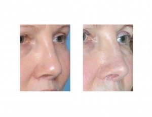 revisiion-rhinoplasty-with-rib-grafts-dr-barry-eppley-indianapolis