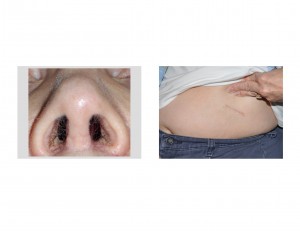 rib-graft-rhinoplasty-scars-dr-barry-eppley-indianapolis