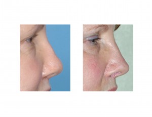 rib-rhinoplasty-revision-dr-barry-eppley-indianapolis