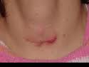 suture-reaction-dr-barry-eppley-indianapolis