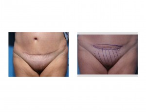 tummy-tuck-revision-dr-barry-eppley-indianapolis