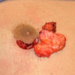areolar-gynecomastia-mass-dr-barry-eppley-indianapolis1