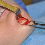 chin-reduction-in-surgery-dr-barry-eppley-indianapolis