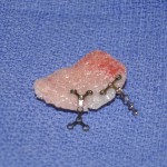 htr-custom-orbital-implant-dr-barry-eppley-indianapolis