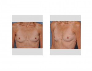 need-for-breast-augmentation-dr-barry-eppley-indianapolis