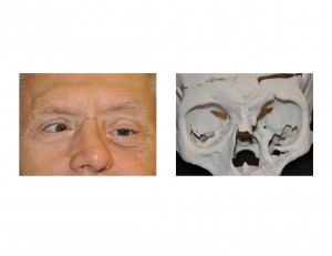 orbital-floor-defect-dr-barry-eppley-indianapolis