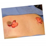 areolar-gynecomastia-excision-dr-barry-eppley-indianapolis1