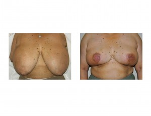 breast-reduction-with-free-nipple-grafting-dr-barry-eppley-indianapolis
