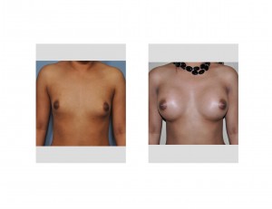 hispanic-breast-augmentation-dr-barry-eppley-indianapolis