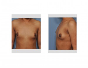 hispanic-need-for-breast-augmentation-dr-barry-eppley-indianapolis