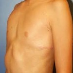 injectable-pectius-excavatum-repair-dr-barry-eppley-indianapolis