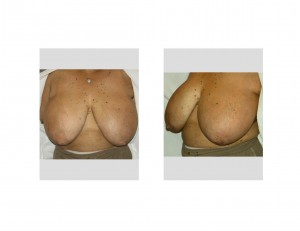 large-breasts-macromastia-dr-barry-eppley-indianapolis