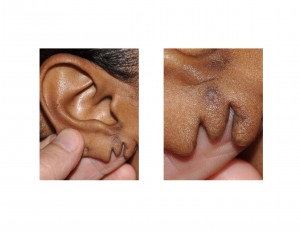 m-split-earlobe-deformity