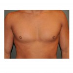 male-nipple-enlargement-dr-barry-eppley-indianapolis2
