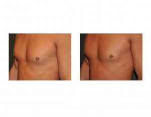male-nipple-reduction-surgery-results-dr-barry-eppley-indianapolis