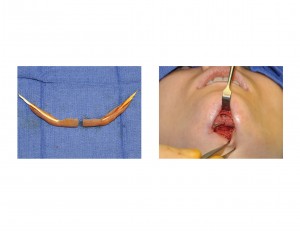 modified-jawline-lengthening-implant-indianapolis-dr-barry-eppley