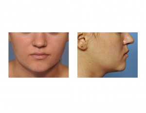 short-lower-facial-height-dr-barry-eppley-indianapolis
