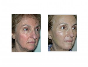 tca-peel-with-facelift-and-rhinoplasty-one-week-postop-dr-barry-eppley-indianapolis