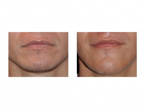 vertical-chin-lengthening-front-view-dr-barry-eppley-indianapolis