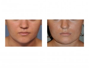 vertical-jaw-lengthening-front-view-dr-barry-eppley-indianapolis