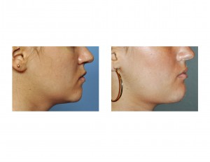 vertical-jaw-lengthening-side-view-dr-barry-eppley-indianapolis