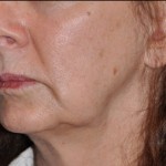 aging-jowls-indianapolis-dr-barry-eppley1