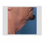 aging-male-neck-dr-barry-eppley-indianapolis
