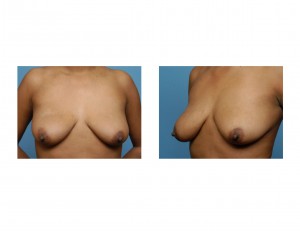 breast-ptosis-dr-barry-eppley-indianapolis