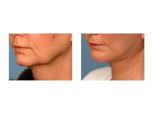 jowlift-limited-facelift-dr-barry-eppley-indianapolis