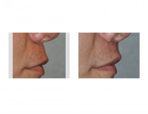subnasal-lip-lift-in-men-side-view-dr-barry-eppley-indianapolis