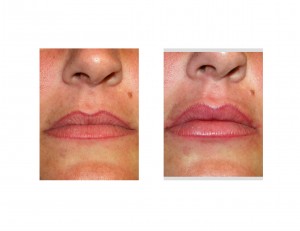 dermal-graft-philtroplasty-dr-barry-eppley-indianapolis