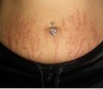 early-stretch-marks-dr-barry-eppley-indianapolis